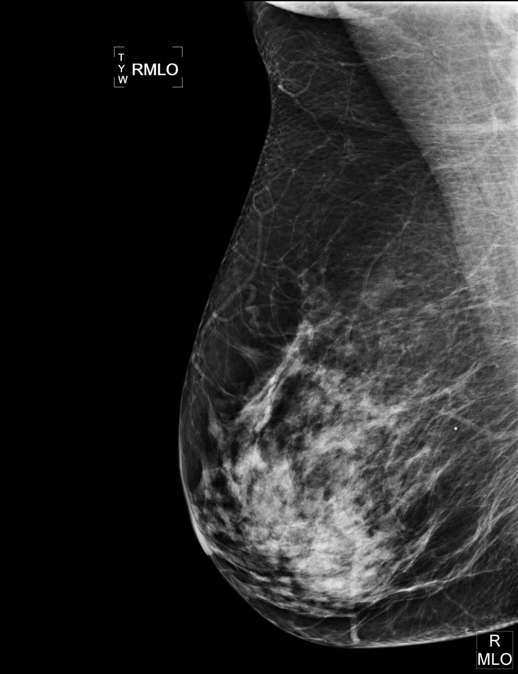 Digital mammography