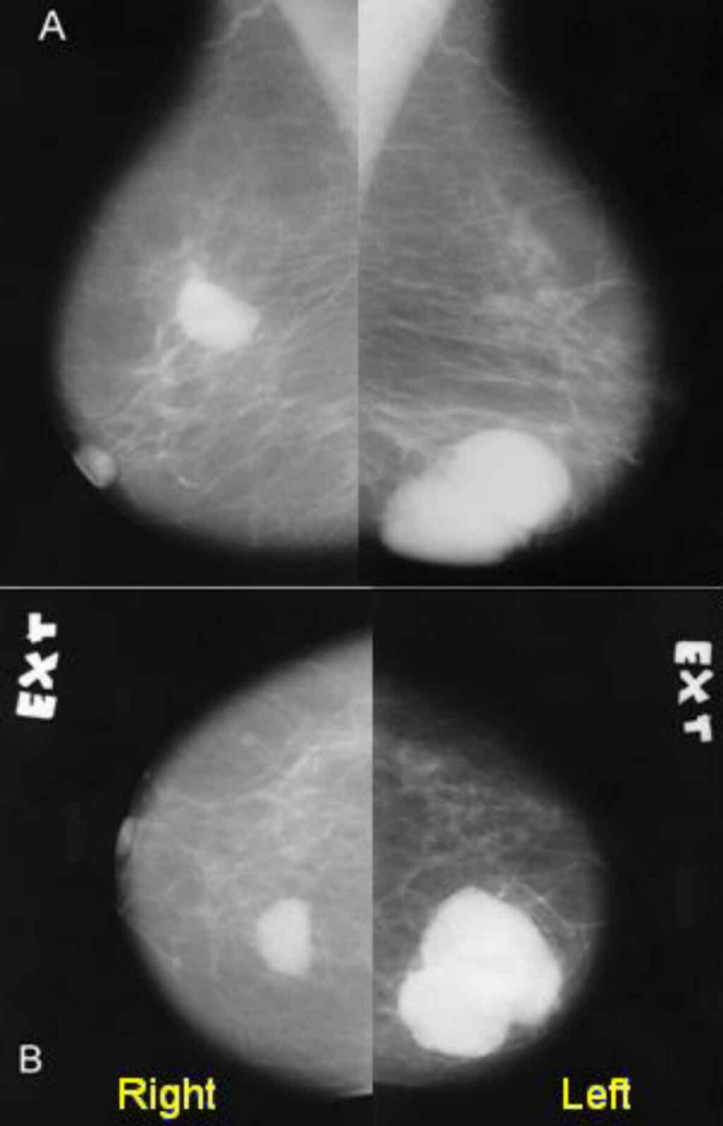 carcinoma_mammella